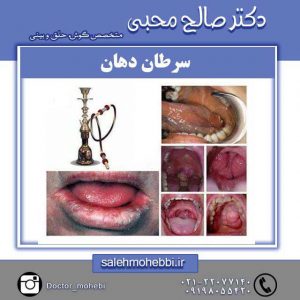 سرطان دهان