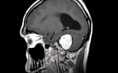 تومور عصبی شنوایی (نوروم آکوستیک)