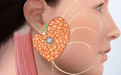 آیا تومورهای غدد بزاقی خطرناک هستند؟
