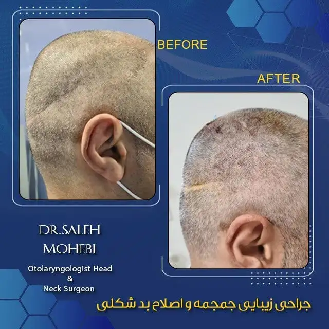 اصلاح بدشکلی جمجمه در بزرگسالان