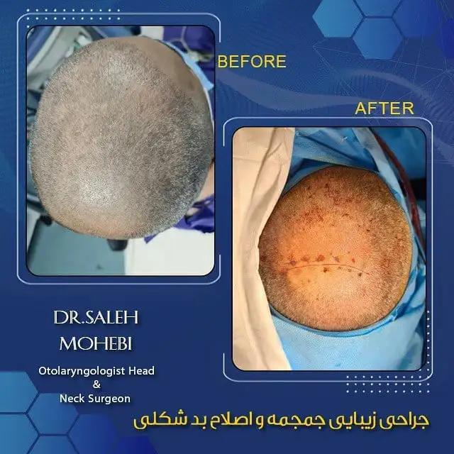 جراحی زیبایی جمجمه سر