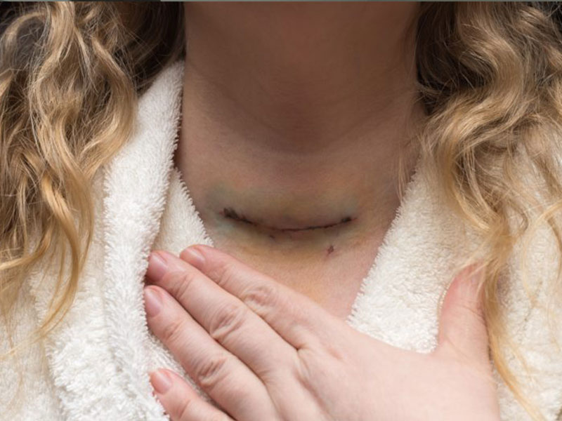 جراحی تیروئید برای چه مشکلاتی تجویز می‌شود؟