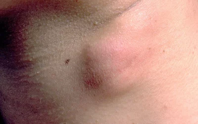 تومورهای خوش خیم گردن: بررسی کامل علل، تشخیص و روشهای درمانی