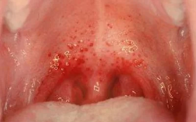 همه چیز درباره فارنژیت؛ از علائم اولیه تا عوارض خطرناک