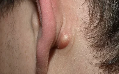 کیست گوش تا چه اندازه میتواند خطرناک باشد؟