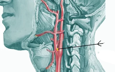 درمان تومور کاروتید: تودههای عروقی گردن خطرناک است؟