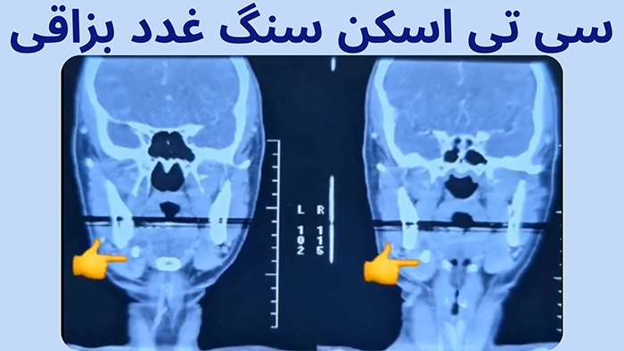 تشخیص سنگ غدد بزاقی